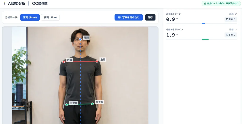 AI姿勢分析ツールで患者様の骨格の歪みやストレートネックが数値化されている画面イメージ